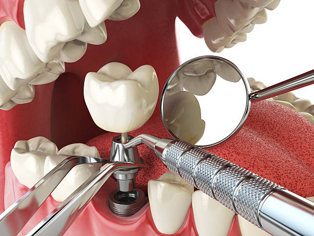 Best Emergency Dental Care for Broken or Chipped Teeth in Caseyvle, IL